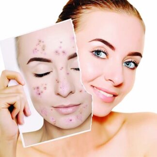Ολοκληρωμένο πρόγραμμα φροντίδας του <strong>ακνεϊκού δέρματος</strong>